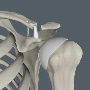 Acromioclavicular (AC) Joint Reconstruction 2