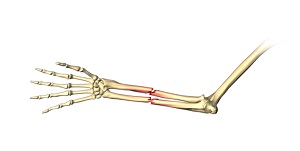 Adult Forearm Fractures