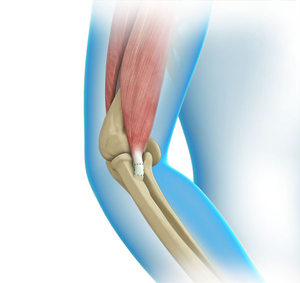 Elbow Tendon & Ligament Repair