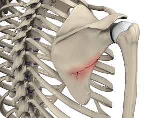 Fracture of the Shoulder Blade (Scapula)