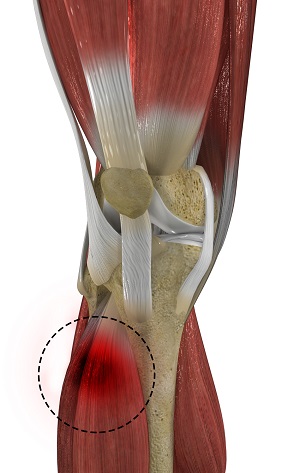 Muscle Injuries