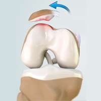 Patellofemoral Instability