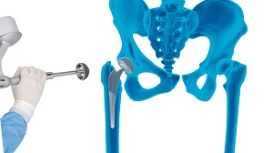 Robotic Total Hip Replacement