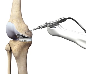 Robotic Unicondylar Knee Replacement