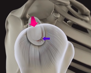 Shoulder Labral Tear with Instability