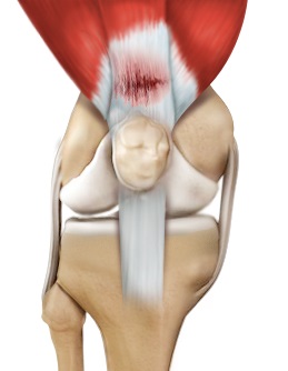 Tendon Injuries