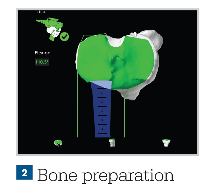 Bone Preparation