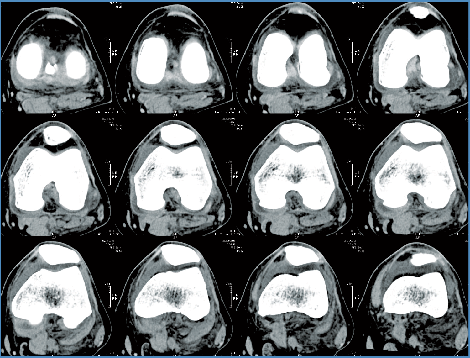 Knee CT Scan Knee CT Scan