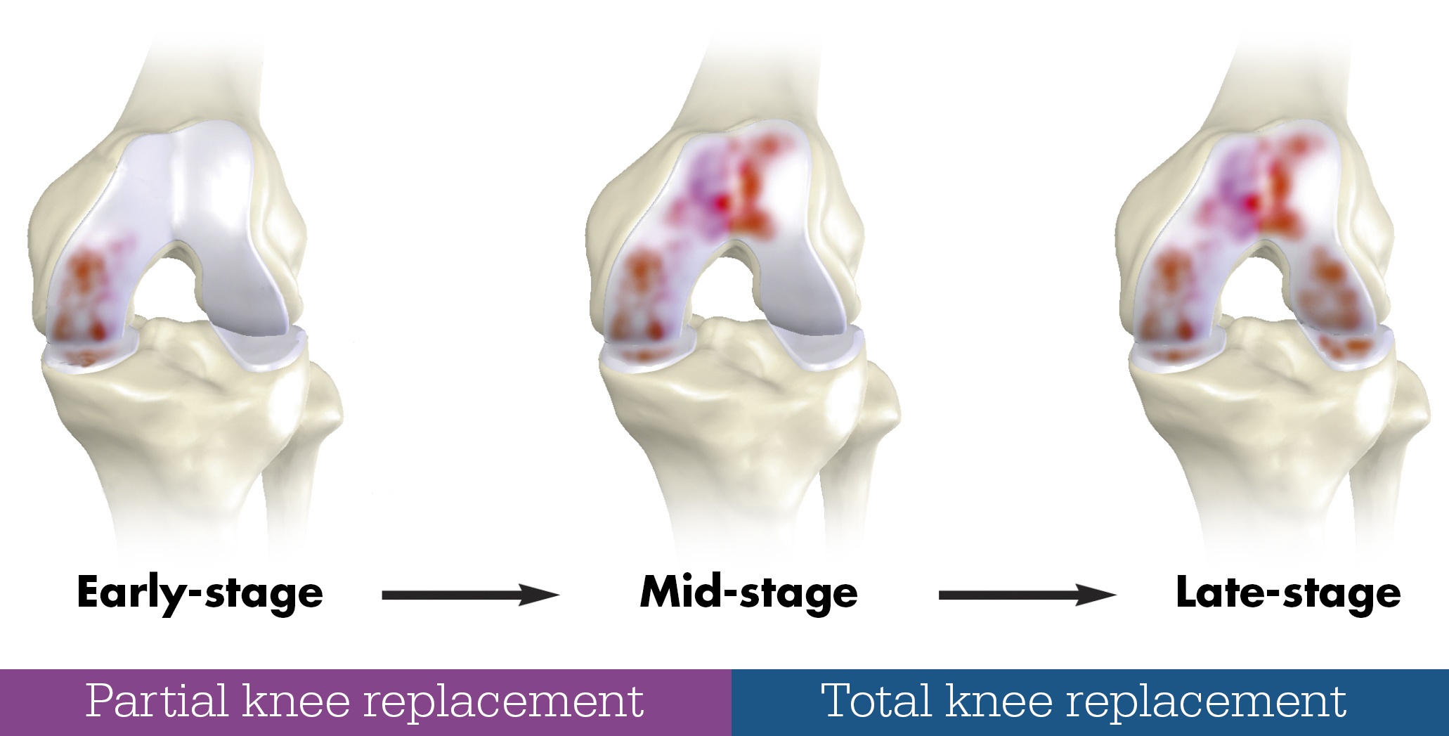 Partial Knee replacement